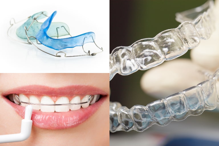 different types of retainers